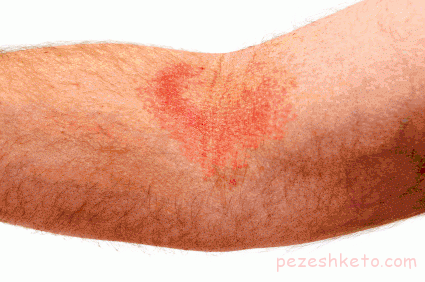 حساسیت پوستی چیست