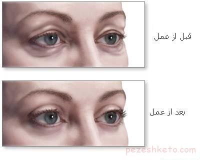 بلفاروپلاستی چیست