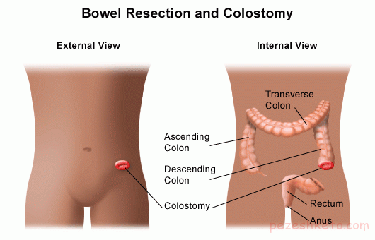 مراقبتهای لازم بعد از کلستومی
