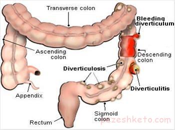 اطلاعاتی درمورد دیورتیکولوز