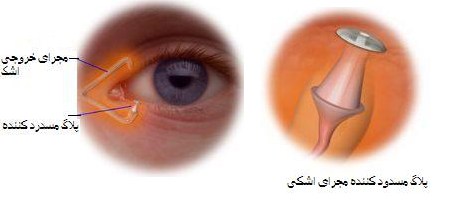 خشکی چشم چیست