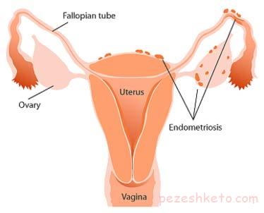 اطلاعاتی درباره آندومتریوز