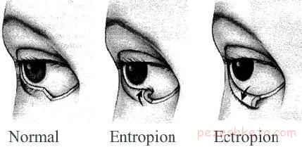 انتروپیون یا چرخیدن پلک به داخل چشم چیست