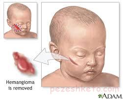 همانژیوم یا ماه گرفتگی چیست