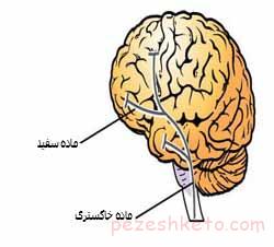 هیستری چیست