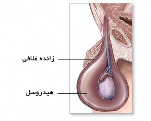 آب آوردن بیضه,هیدروسل چیست,علل هیدروسل