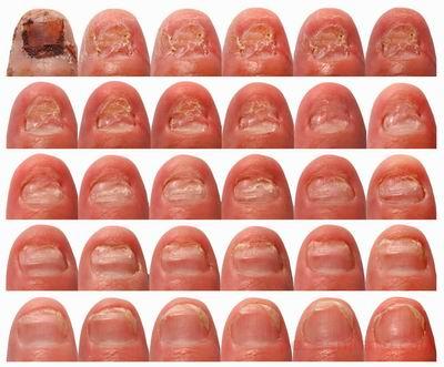 عفونت قارچ ناخن