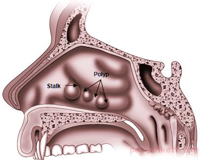 اطلاعاتی جامع درباره پولیپ بینی