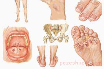 عفونتهای دوران بارداری