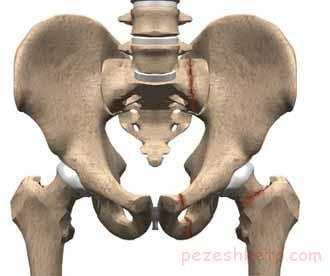 آرتروز لگن چیست