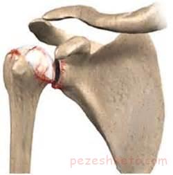 آرتروز مفصل هیپ
