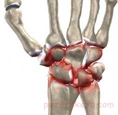 آرتروز مچ دست