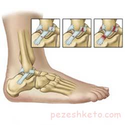 آرتروز مچ پا