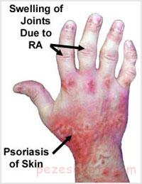 آرتریت عفونی چیست