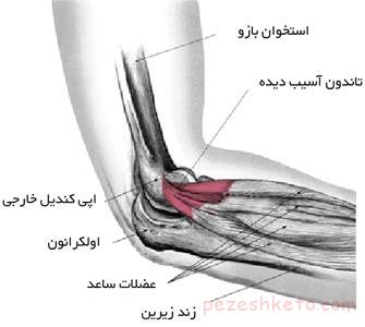 بیماری آرنج تنیس باز