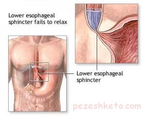 بیماری آشالازی چیست