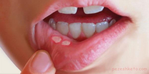 علل آفت دهان چیست