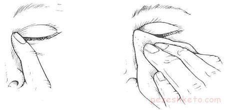 حساسیت بهاری چشم چیست