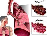 مقاله درباره بیماری آمفیزم