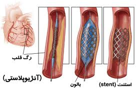 آنژیوپلاستی کرونری چیست