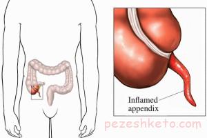 علائم آپاندیسیت چیست