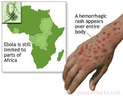 بیماری ابولا