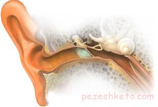اتواسکلروز چیست