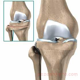 عمل جراحی استئوتومی