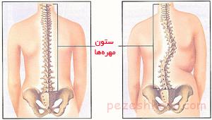 اسكوليوز چیست