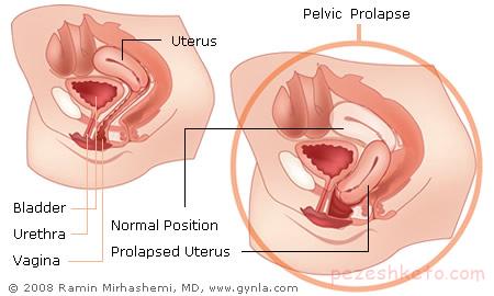 افتادگی رحم