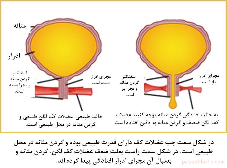 افتادگی مثانه چیست