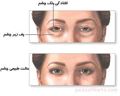 علل افتادگی پلک چیست
