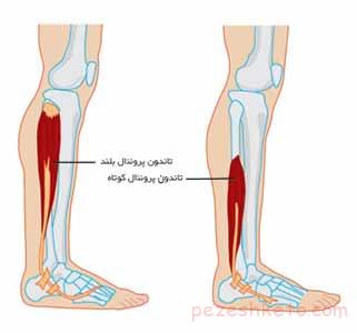التهاب تاندون پرونئال