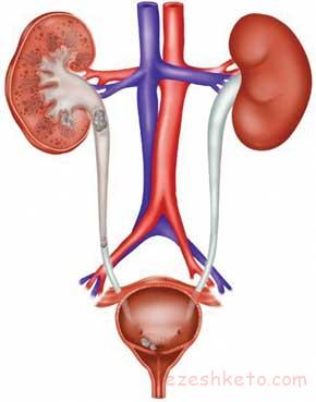 التهاب مثانه چیست