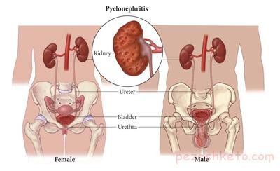 التهاب کلیه