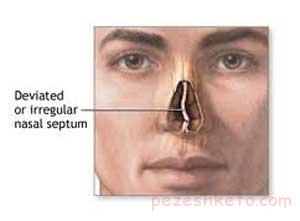 اطلاعاتی درباره انحراف بینی