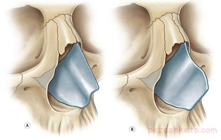 انحراف تیغه بینی چیست