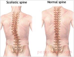 ناهنجاری ستون فقرات در اثر کار با رایانه