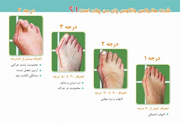 انحراف شست پا