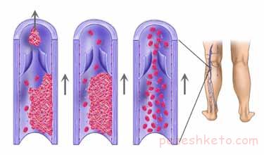 علل لخته شدن خون چیست