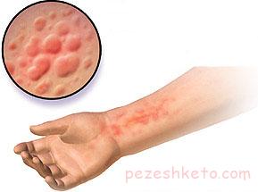 درباره اگزمای تماسی