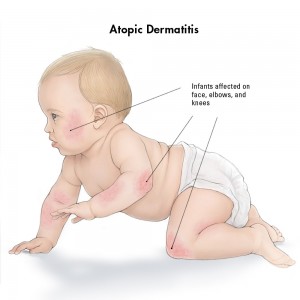 اگزمای سرشتی چیست