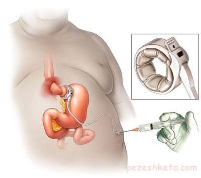 بالون معده چیست