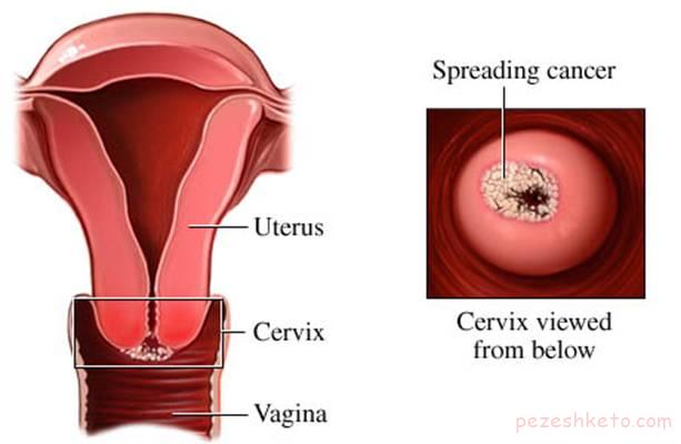 برفک واژن چیست