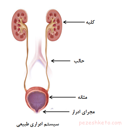 برگشت ادرار به مثانه - ریفلاکس ادراری
