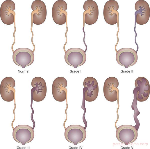 برگشت ادرار در اطفال چیست