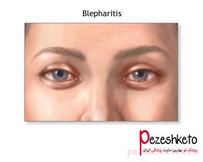 شوره مژه یا بلفاریت چیست