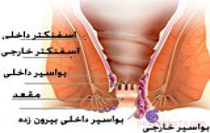 بواسیر یا هموروئید و درمان آن