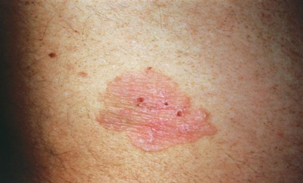 بيماری بوون