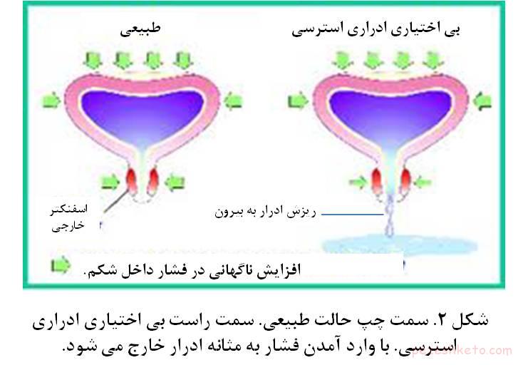 مقاله درباره بی اختیاری ادرار در خانمها